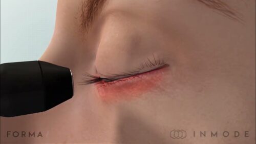 Inmode FORMA i - радиочестотна терапия при сухо око